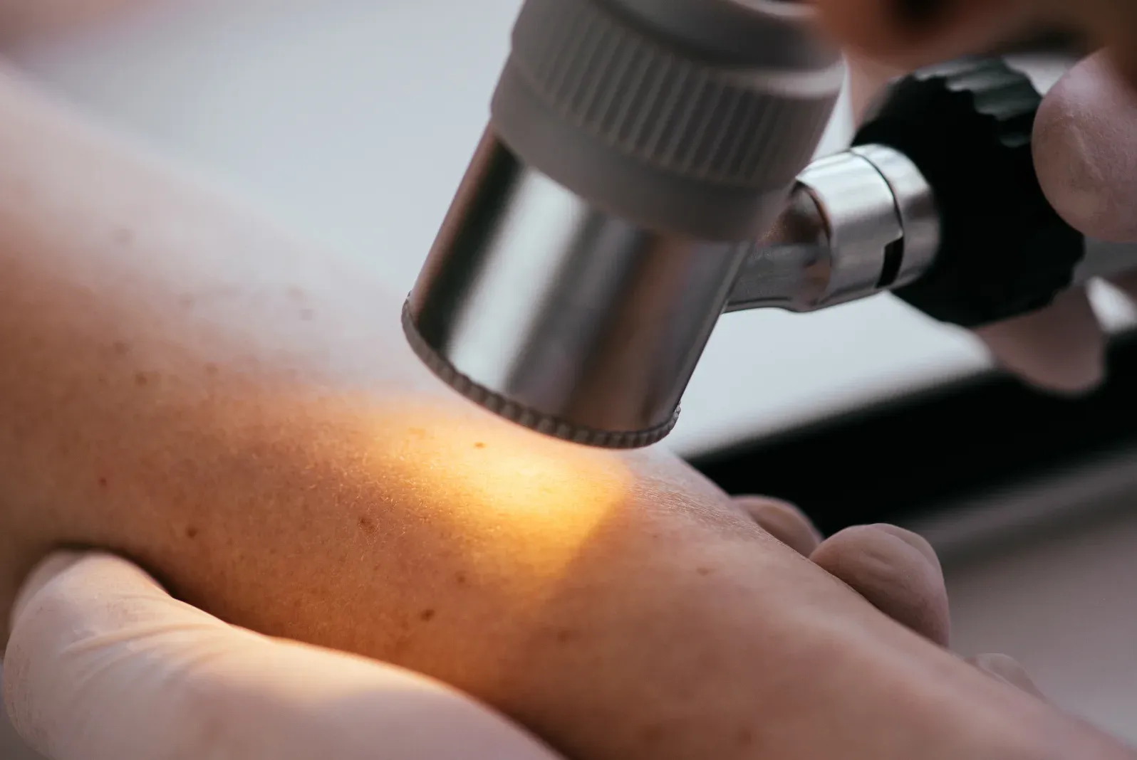 A dermatologist examining a mole on a patient's arm with a dermatoscope