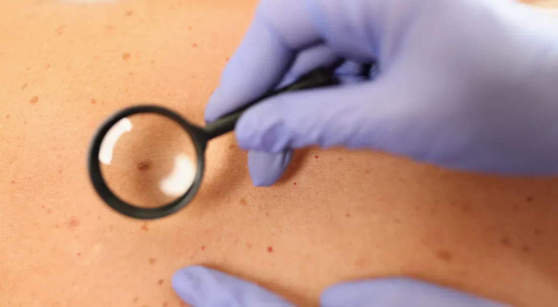 Magnifying glass over a mole on the skin