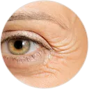 Neurotoxin Services - Palm Beach Dermatology Group - Crows Feet