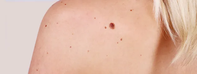Mohs Surgery - Palm Beach Dermatology Group
