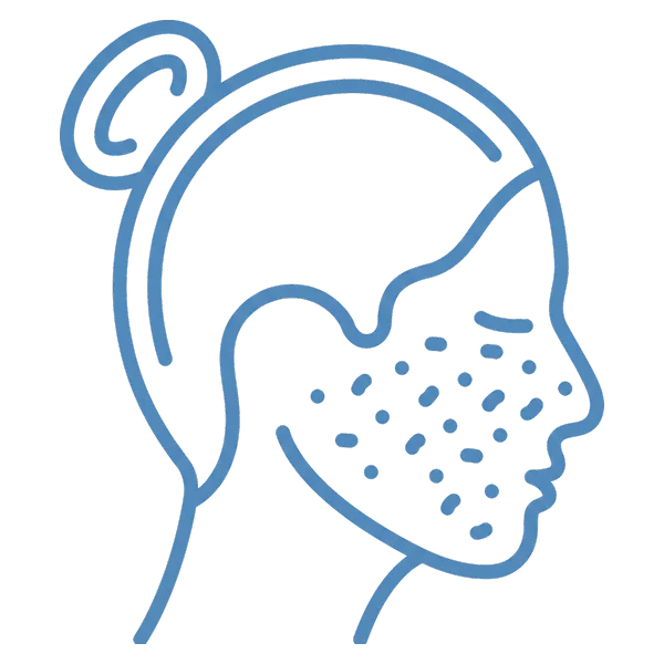 Acne and Hair Loss