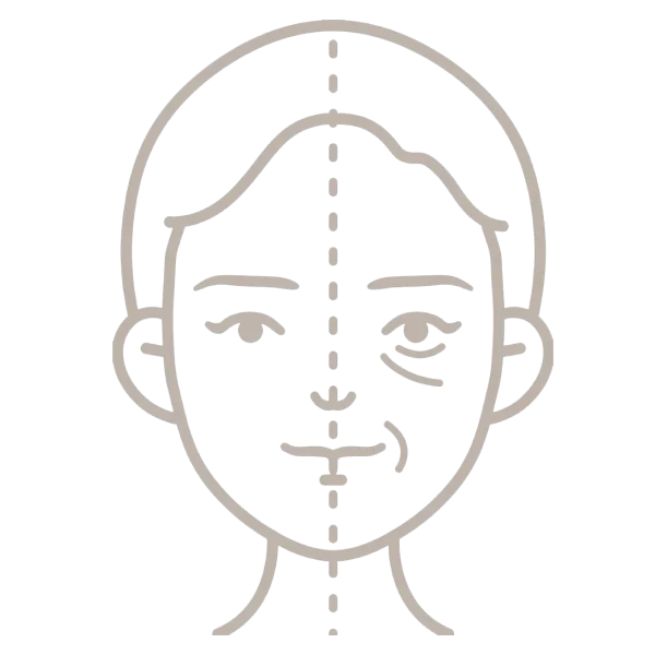 Microneedling RF