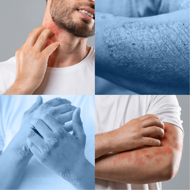 Itching and Skin Irritations - Palm Beach Dermatology Group