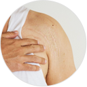Potenza Radio Frequency Microneedling Treatment - Stretch marks - Palm Beach Dermatology Group