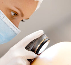 Benign Moles Removal - Medical Treatment - Palm Beach Dermatology Group Florida