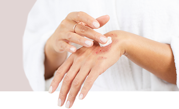 Eczema Treatment - Medical Dermatology - Palm Beach Dermatology Group