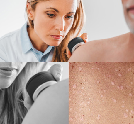 Eczema Treatment - Medical Dermatology - Palm Beach Dermatology Group