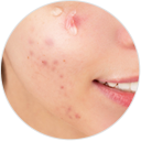 Potenza Radio Frequency Microneedling Treatment - Acne Scars - Palm Beach Dermatology Group