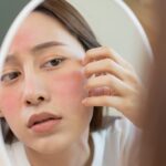 Discovering the Best Skincare for Rosacea: Effective Strategies for Management - Palm Beach Dermatology Group - PGA Dermatology Skin & Aesthetics Center