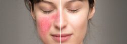 Discovering the Best Skincare for Rosacea: Effective Strategies for Management - Palm Beach Dermatology Group