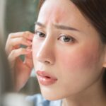 7 Answers to Why Is My Face Always Red? - Palm Beach Dermatology Group - Constant Facial Redness - Dermatology Clinic - Dermatology Consult - Skin Care Clinic - PGA Dermatology Skin & Aesthetics Center
