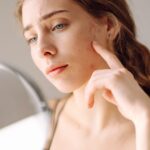 How To Get Rid Of Acne Scars? A Complete Guide - Palm Beach Dermatology Group - Dermatology Clinic - Dermatology Palm Beach - PGA Dermatology Skin & Aesthetics Center