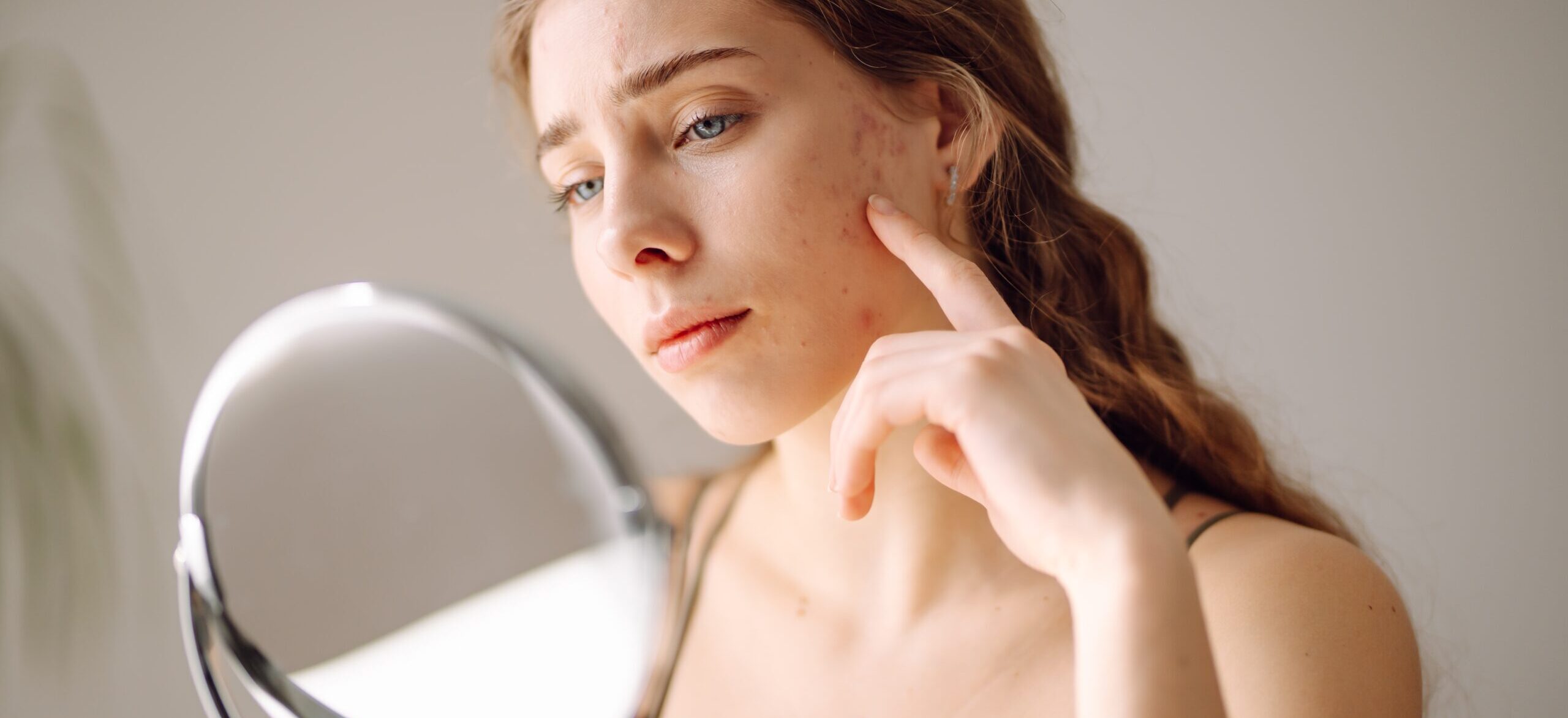 How To Get Rid Of Acne Scars? A Complete Guide - Palm Beach Dermatology Group - Dermatology Clinic - Dermatology Palm Beach - PGA Dermatology Skin & Aesthetics Center