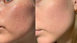 How To Get Rid Of Acne - A Complete Guide - Palm Beach Dermatology Group - Dermatology Clinic - Dermatology Palm Beach - PGA Dermatology Skin & Aesthetics Center