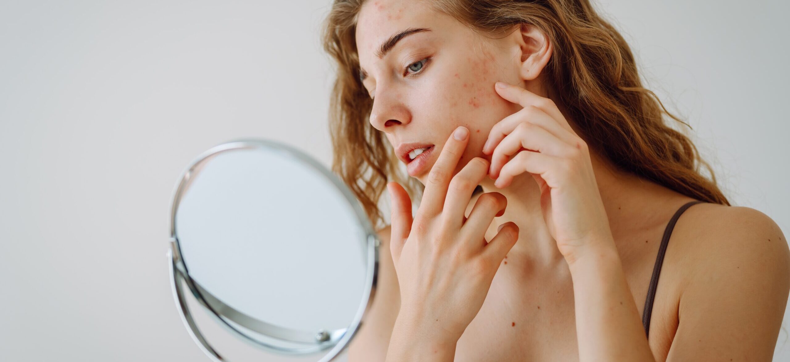 How to Get Rid of Forehead Acne: Simple Tips for Clear Skin - How to Prevent Forehead Acne - Simple Skincare Habits for Clear Skin - Palm Beach Dermatology Group - PGA Dermatology Skin & Aesthetics Center