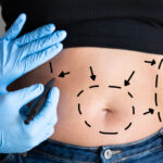 Does Liposuction Leave Scars? - Understanding the Liposuction Procedure - Tumescent Liposuction - Laser-Assisted Liposuction (LAL) - Ultrasound-Assisted Liposuction (UAL) - Do Liposuction Scars Happen? - Ready to Learn More About Liposuction and Scarring?