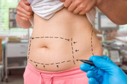 How Painful Is Liposuction? What to Expect - What is Liposuction?: Traditional Liposuction - Laser-Assisted Liposuction (SmartLipo) - Ultrasound-Assisted Liposuction (VASER) - Factors That Affect Pain During Liposuction - Pain After Liposuction - Recovery and Pain After Liposuction