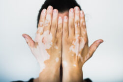 What is Vitiligo? A Simple Guide / What is Vitiligo / Common Signs of Vitiligo / Is Vitiligo Contagious or Dangerous / What Causes Vitiligo / Types of Vitiligo / Who Can Get Vitiligo / How is Vitiligo Diagnosed / Can Vitiligo Be Treated / Living with Vitiligo / Palm Beach Dermatology Group / PGA Dermatology / Florida