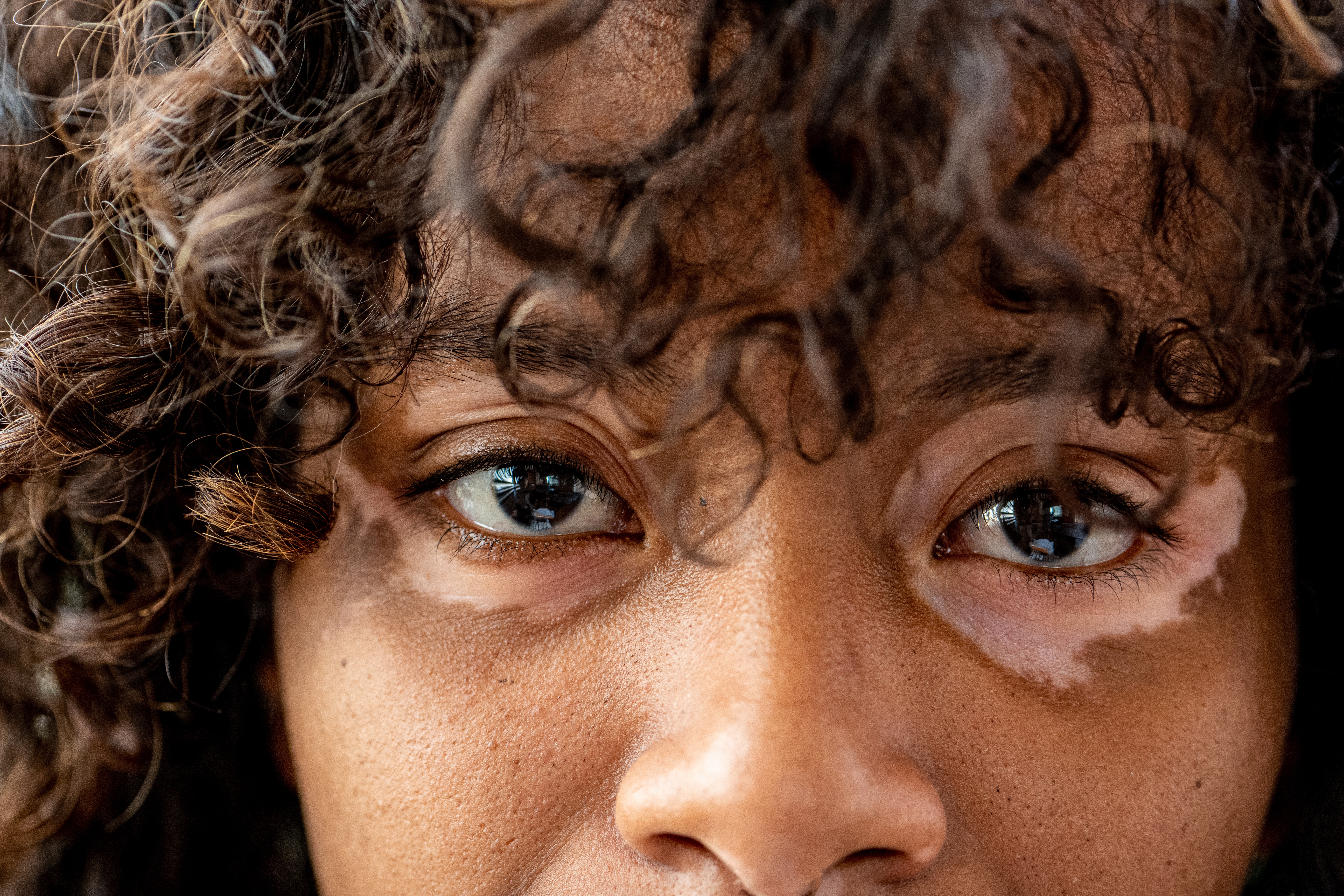 Is Vitiligo Genetic? A Complete Guide / What Is Vitiligo / What Causes Vitiligo? / Is Vitiligo Genetic? / Genes Connected to Vitiligo / Can You Inherit Vitiligo from a Parent? / Other Things That Can Raise Your Risk Besides Genetics / What to Do If Vitiligo Runs in Your Family / Palm Beach Dermatology - Dermatologist in Palm Beach - PGA Dermatology - Vitiligo Treatment - Skincare
