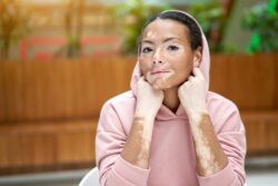 What is Vitiligo? A Simple Guide / What is Vitiligo / Common Signs of Vitiligo / Is Vitiligo Contagious or Dangerous / What Causes Vitiligo / Types of Vitiligo / Who Can Get Vitiligo / How is Vitiligo Diagnosed / Can Vitiligo Be Treated / Living with Vitiligo / Palm Beach Dermatology Group / PGA Dermatology / Florida