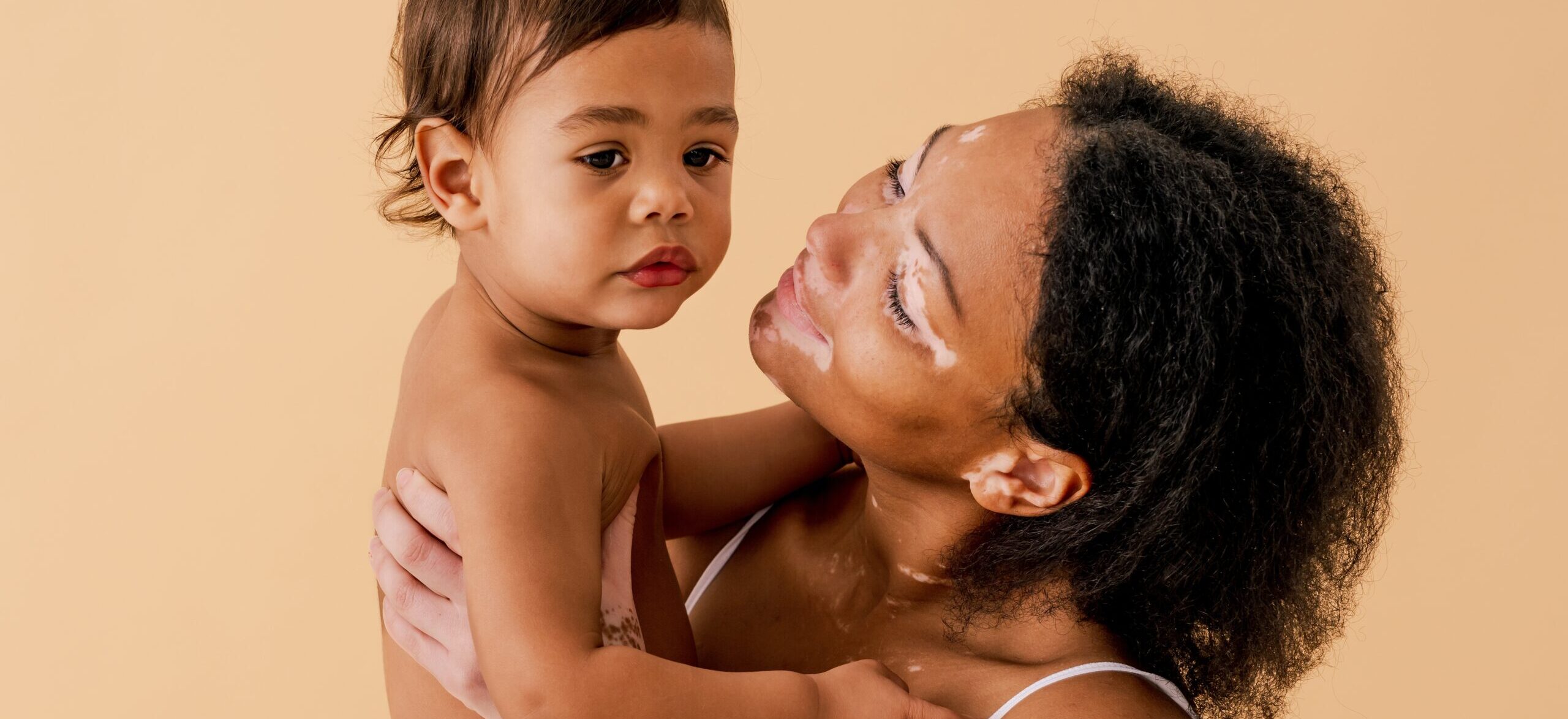 Is Vitiligo Genetic? A Complete Guide / What Is Vitiligo / What Causes Vitiligo? / Is Vitiligo Genetic? / Genes Connected to Vitiligo / Can You Inherit Vitiligo from a Parent? / Other Things That Can Raise Your Risk Besides Genetics / What to Do If Vitiligo Runs in Your Family / Palm Beach Dermatology - Dermatologist in Palm Beach - PGA Dermatology - Vitiligo Treatment - SkincareIs Vitiligo Genetic? A Complete Guide / What Is Vitiligo / What Causes Vitiligo? / Is Vitiligo Genetic? / Genes Connected to Vitiligo / Can You Inherit Vitiligo from a Parent? / Other Things That Can Raise Your Risk Besides Genetics / What to Do If Vitiligo Runs in Your Family / Palm Beach Dermatology - Dermatologist in Palm Beach - PGA Dermatology - Vitiligo Treatment - Skincare