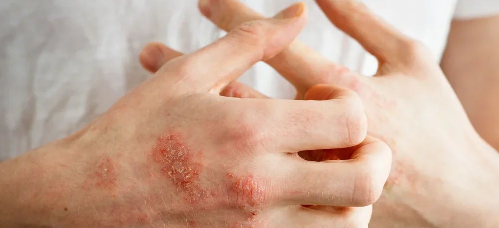 What Causes Eczema? Understanding the Triggers and How to Manage It / What Is Eczema? / Understanding the Skin’s Role in Eczema / Common Causes and Triggers of Eczema / How Lifestyle and Diet Impact Eczema / Diet and Eczema / Stress and Eczema / Environmental Triggers for Eczema / How to Manage and Prevent Eczema Flare-Ups / Living with Eczema: Final Thoughts / Palm Beach Dermatology Group - PGA Dermatology Skin & Aesthetics Center