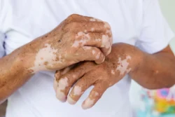 Close-up Vitiligo on skin hands of old people. medical condition causing depigmentation of patches of skin / What Causes Vitiligo? Signs, Types, Causes & Diagnosis / What Is Vitiligo? / Common signs and symptoms / Types of vitiligo / What Causes Vitiligo? / Is Vitiligo Hereditary? / Common Myths and Misconceptions / Can Emotional Stress Cause Vitiligo / Associated Medical Conditions / Diagnosing Vitiligo