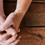 A woman holding hands on a wooden background. has skin disorder called vitiligo - white patches caused by loss of pigmentation / What Causes Vitiligo? Signs, Types, Causes & Diagnosis / What Is Vitiligo? / Common signs and symptoms / Types of vitiligo / What Causes Vitiligo? / Is Vitiligo Hereditary? / Common Myths and Misconceptions / Can Emotional Stress Cause Vitiligo / Associated Medical Conditions / Diagnosing Vitiligo