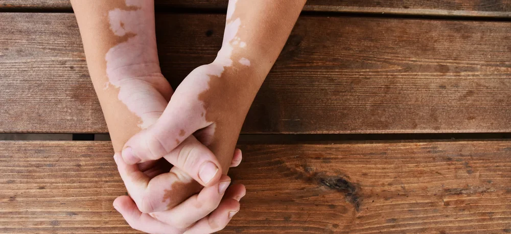 A woman holding hands on a wooden background. has skin disorder called vitiligo - white patches caused by loss of pigmentation / What Causes Vitiligo? Signs, Types, Causes & Diagnosis / What Is Vitiligo? / Common signs and symptoms / Types of vitiligo / What Causes Vitiligo? / Is Vitiligo Hereditary? / Common Myths and Misconceptions / Can Emotional Stress Cause Vitiligo / Associated Medical Conditions / Diagnosing Vitiligo