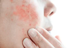 What is Eczema? A Simple Guide to Symptoms, Causes, and Treatment / Types of Eczema: Atopic Dermatitis - Contact Dermatitis - Dyshidrotic Eczema - Nummular Eczema - Seborrheic Dermatitis - Stasis Dermatitis / What Causes Eczema? / Symptoms of Eczema / Who Gets Eczema? / How is Eczema Diagnosed? / Prescription Creams and Medications / Palm Beach Dermatology Group - PGA Dermatology