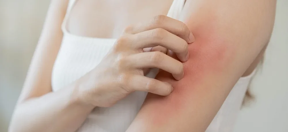 What is Eczema? A Simple Guide to Symptoms, Causes, and Treatment / Types of Eczema: Atopic Dermatitis - Contact Dermatitis - Dyshidrotic Eczema - Nummular Eczema - Seborrheic Dermatitis - Stasis Dermatitis / What Causes Eczema? / Symptoms of Eczema / Who Gets Eczema? / How is Eczema Diagnosed? / Prescription Creams and Medications / Palm Beach Dermatology Group - PGA Dermatology