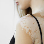 Can White People Have Vitiligo? / What Is Vitiligo? / Can White People Have Vitiligo? / Why Is Vitiligo Less Noticeable in White People? / Causes of Vitiligo / How Is Vitiligo Diagnosed in White People? / Treatment Options / Emotional and Psychological Impact of Vitiligo / Famous White People with Vitiligo / Common Myths Debunked / Can Vitiligo Be Prevented? / PGA Dermatology / Palm Beach Dermatology Group / Palm Beach Dermatologist