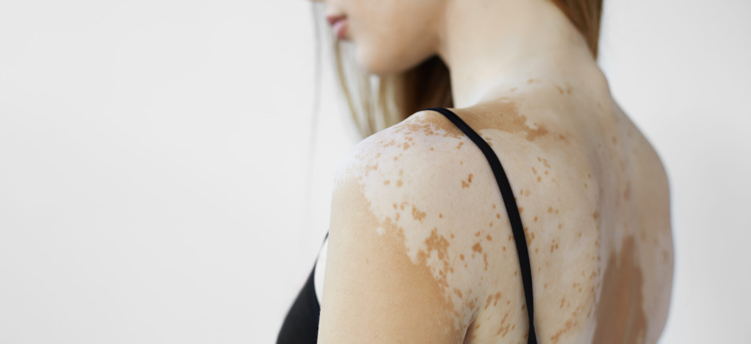 Can White People Have Vitiligo? / What Is Vitiligo? / Can White People Have Vitiligo? / Why Is Vitiligo Less Noticeable in White People? / Causes of Vitiligo / How Is Vitiligo Diagnosed in White People? / Treatment Options / Emotional and Psychological Impact of Vitiligo / Famous White People with Vitiligo / Common Myths Debunked / Can Vitiligo Be Prevented? / PGA Dermatology / Palm Beach Dermatology Group / Palm Beach Dermatologist