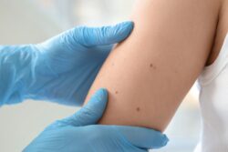 Can White People Have Vitiligo? / What Is Vitiligo? / Can White People Have Vitiligo? / Why Is Vitiligo Less Noticeable in White People? / Causes of Vitiligo / How Is Vitiligo Diagnosed in White People? / Treatment Options / Emotional and Psychological Impact of Vitiligo / Famous White People with Vitiligo / Common Myths Debunked / Can Vitiligo Be Prevented? / PGA Dermatology / Palm Beach Dermatology Group / Palm Beach Dermatologist