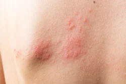 Is Eczema Contagious? / What is Eczema? /  What Causes Eczema? /  How Do You Treat Eczema? / Eczema and Social Interaction / Managing Eczema in Children /  Workplace Considerations for Adults with Eczema / Common Myths About Eczema / When to See a Doctor / Palm Beach Dermatology Group / Dermatologist in Palm Beach