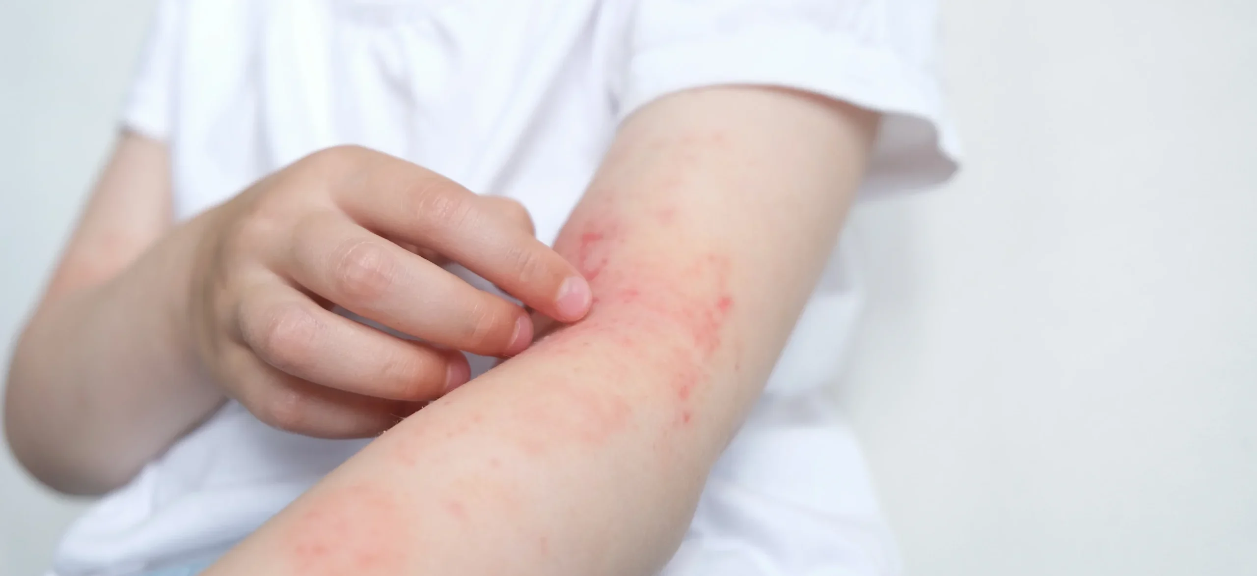 Is Eczema Contagious? / What is Eczema? / What Causes Eczema? / How Do You Treat Eczema? / Eczema and Social Interaction / Managing Eczema in Children / Workplace Considerations for Adults with Eczema / Common Myths About Eczema / When to See a Doctor / Palm Beach Dermatology Group / Dermatologist in Palm Beach