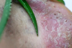 How to Cure Eczema Permanently? / What is Eczema? / What Causes Eczema? / Types of Eczema / Symptoms of Eczema / Managing Eczema: Treatment Options / Lifestyle Changes to Manage Eczema / Home Remedies for Eczema Relief / When to Seek Professional Help / Long-Term Management of Eczema / Prevention Tips to Minimize Eczema Flare-Ups / When To See A Doctor / Managing Eczema For A Better Quality of Life / Palm Beach Dermatology Group / PGA Dermatology