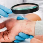 How to Cure Eczema Permanently? / What is Eczema? / What Causes Eczema? / Types of Eczema / Symptoms of Eczema / Managing Eczema: Treatment Options / Lifestyle Changes to Manage Eczema / Home Remedies for Eczema Relief / When to Seek Professional Help / Long-Term Management of Eczema / Prevention Tips to Minimize Eczema Flare-Ups / When To See A Doctor / Managing Eczema For A Better Quality of Life / Palm Beach Dermatology Group / PGA Dermatology