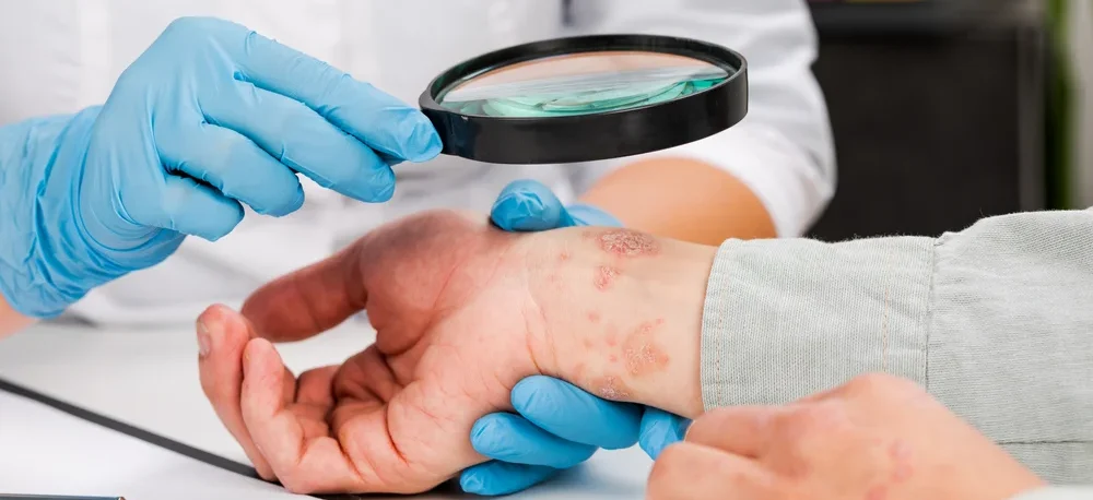 How to Cure Eczema Permanently? / What is Eczema? / What Causes Eczema? / Types of Eczema / Symptoms of Eczema / Managing Eczema: Treatment Options / Lifestyle Changes to Manage Eczema / Home Remedies for Eczema Relief / When to Seek Professional Help / Long-Term Management of Eczema / Prevention Tips to Minimize Eczema Flare-Ups / When To See A Doctor / Managing Eczema For A Better Quality of Life / Palm Beach Dermatology Group / PGA Dermatology
