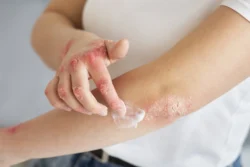 Is Eczema an Autoimmune Disease? What You Really Need to Know / What Is Eczema and What Does It Look Like? / Why People Think Eczema Might Be Autoimmune / How Eczema Is Different from Autoimmune Conditions / The Role of the Immune System in Eczema / Can Eczema Be Related to Other Immune Issues? / What Doctors and Researchers Say About It / Could Science Change That in the Future? / Why Knowing the Difference Matters / Pharmacy CareRX