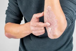 Can Eczema Cream Have Side Effects? / What Is Eczema? / Can Eczema Cream Have Side Effects? / Types of Eczema Creams and Their Potential Side Effects: Corticosteroid Eczema Creams - Non-Steroidal Eczema Creams - Moisturizing Eczema Creams / How to Minimize the Risk of Side Effects / Palm Beach Dermatology Group / PGA Dermatologist