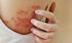 How to Prevent Eczema? A Comprehensive Guide / What Is Eczema? / Key Triggers of Eczema Flare-Ups / How To Prevent Eczema: Top Tips and Practices / Maintain a Consistent Skincare Routine / Protect Your Skin From Harsh Environmental Conditions / When to Seek Medical Help / FAQs About Eczema / Palm Beach Dermatology Gruop / PGA Dermatology