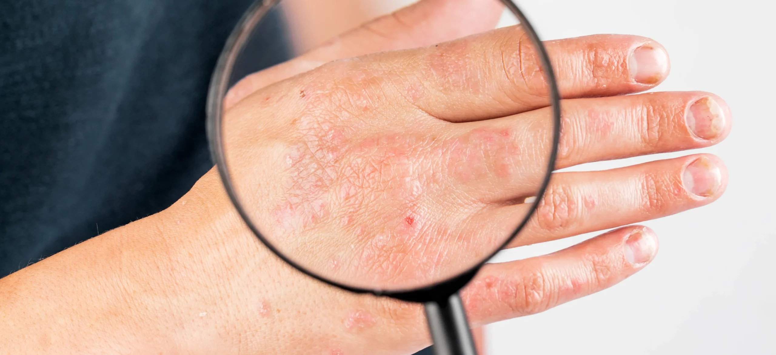 Is Eczema an Autoimmune Disease? What You Really Need to Know / What Is Eczema and What Does It Look Like? / Why People Think Eczema Might Be Autoimmune / How Eczema Is Different from Autoimmune Conditions / The Role of the Immune System in Eczema / Can Eczema Be Related to Other Immune Issues? / What Doctors and Researchers Say About It / Could Science Change That in the Future? / Why Knowing the Difference Matters / Pharmacy CareRX