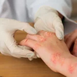 Safest Eczema Treatments: Effective Solutions for Skin Health / Understanding Eczema and Its Causes / Top Treatment for Managing Eczema Safely / How to Prevent Eczema Flare-Ups: Practical Tips / Choosing the Right Eczema Treatment for Your Skin / Palm Beach Dermatology Group - PGA Dermatology
