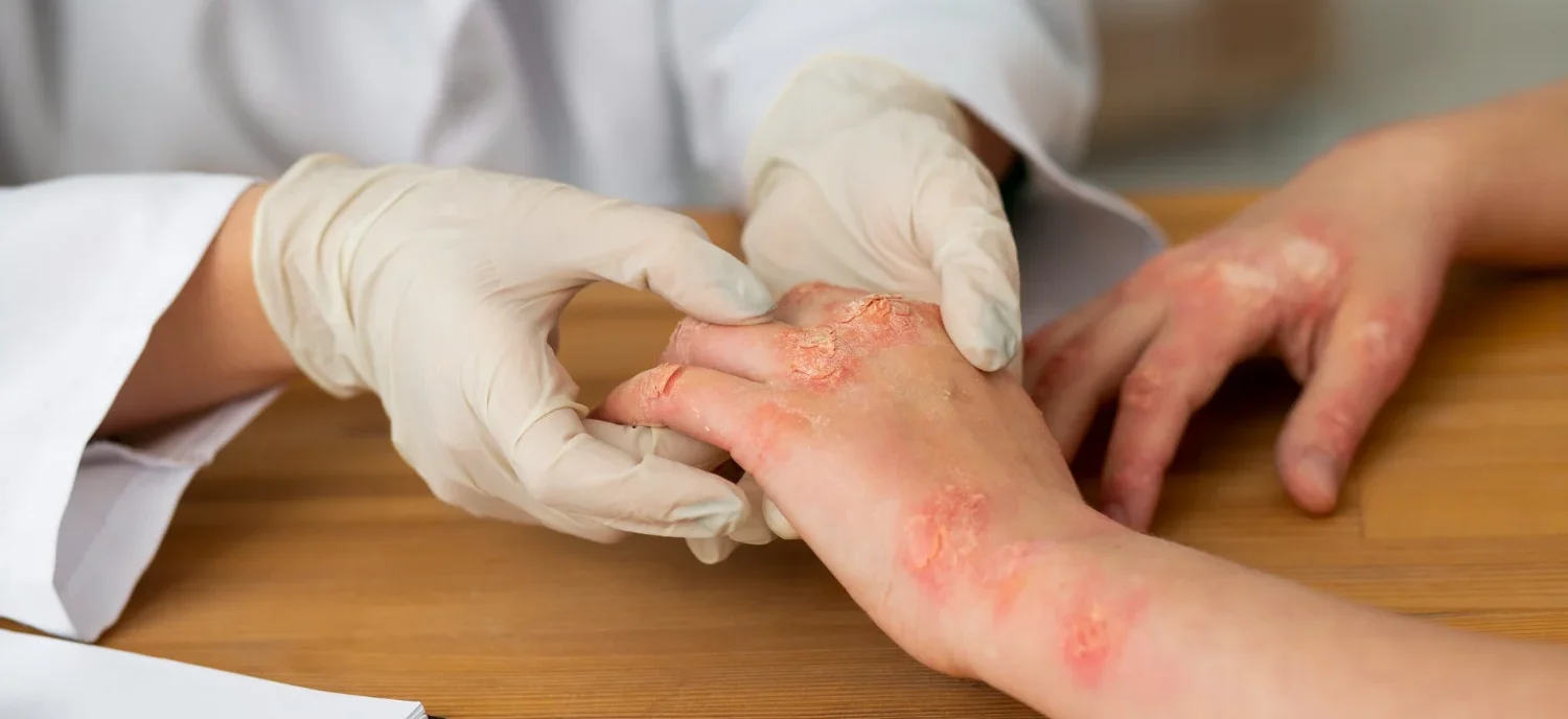 Safest Eczema Treatments: Effective Solutions for Skin Health / Understanding Eczema and Its Causes / Top Treatment for Managing Eczema Safely / How to Prevent Eczema Flare-Ups: Practical Tips / Choosing the Right Eczema Treatment for Your Skin / Palm Beach Dermatology Group - PGA Dermatology