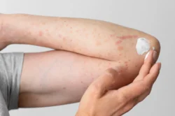 Are Hives Contagious? A Simple Guide / What Are Hives? / What Do Hives Look and Feel Like? / Are Hives Contagious? / When the Underlying Cause Might Be Contagious / Other Common Causes of Hives / Can Children Get Hives? / How Are Hives Diagnosed? / How Are Hives Treated? / When to See a Doctor / Chronic Hives and Quality of Life / What You Should Remember / Palm Beach Dermatology Group / PGA Dermatology