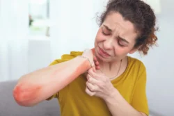 Are Hives Contagious? A Simple Guide / What Are Hives? / What Do Hives Look and Feel Like? / Are Hives Contagious? / When the Underlying Cause Might Be Contagious / Other Common Causes of Hives / Can Children Get Hives? / How Are Hives Diagnosed? / How Are Hives Treated? / When to See a Doctor / Chronic Hives and Quality of Life / What You Should Remember / Palm Beach Dermatology Group / PGA Dermatology