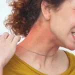 Are Hives Contagious? A Simple Guide / What Are Hives? / What Do Hives Look and Feel Like? / Are Hives Contagious? / When the Underlying Cause Might Be Contagious / Other Common Causes of Hives / Can Children Get Hives? / How Are Hives Diagnosed? / How Are Hives Treated? / When to See a Doctor / Chronic Hives and Quality of Life / What You Should Remember / Palm Beach Dermatology Group / PGA Dermatology