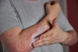How Long Do Hives Last? / What Are Hives? / How Long Do Hives Usually Last? / Acute Hives / Chronic Hives / How Long Does Each Individual Hive Last? / What Affects How Long Hives Last? / The Cause of the Hives / Your Immune System / Medications or Treatment / Stress and Emotional Factors / Can You Speed Up the Healing of Hives? /When Should You See a Doctor? / What Is the Outlook for People With Hives? / Can Hives Come Back After They Go Away? / Can Hives Last for Months or Years? / Palm Beach Dermatology Beach / PGA Dermatology