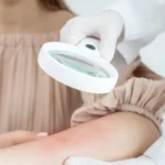 How Long Do Hives Last? / What Are Hives? / How Long Do Hives Usually Last? / Acute Hives / Chronic Hives / How Long Does Each Individual Hive Last? / What Affects How Long Hives Last? / The Cause of the Hives / Your Immune System / Medications or Treatment / Stress and Emotional Factors / Can You Speed Up the Healing of Hives? /When Should You See a Doctor? / What Is the Outlook for People With Hives? / Can Hives Come Back After They Go Away? / Can Hives Last for Months or Years? / Palm Beach Dermatology Beach / PGA Dermatology